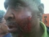 This is what the Welkom Police did to an innocent Man/a Father, shot him in the face for doing nothing...! He was just standing next to the group of singing residents and he got shot. How do you calm down singing residents by shooting at them for singing. They are to be blamed, they even shot kids...!