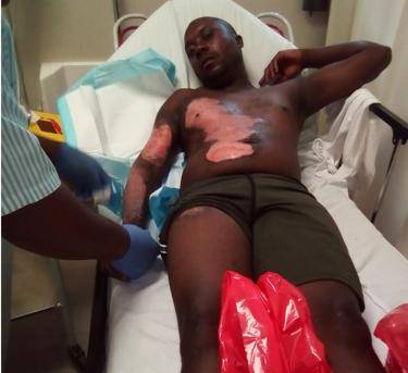 Frans Ngobeni is nursing some burn wounds after his girlfriend allegedly poured boiling water on him. 
