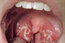 What's causing those white spots in your mouth and throat?
