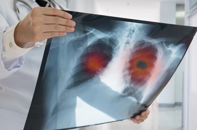 Lung Cancer. Doctor check up x-ray image have prob