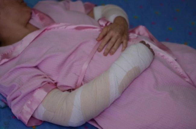 Karin van Straaten's bandaged wound