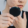 What is cystic acne? And when should you see a doctor?
