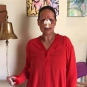 Cancer battle: Mom loses nose but is determined to wed