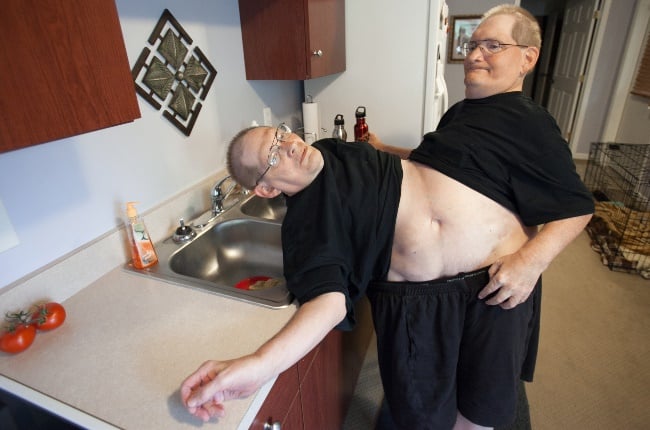 Conjoined twins Ronnie and Donnie Galyon spent the first two years of their lives in hospital. (PHOTO; AP)