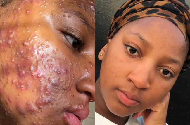 18-year-old Tshego Mokate now has flawless skin.