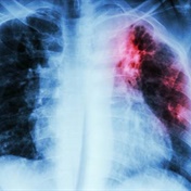 WHO estimates 20% more TB cases in SA than previously thought