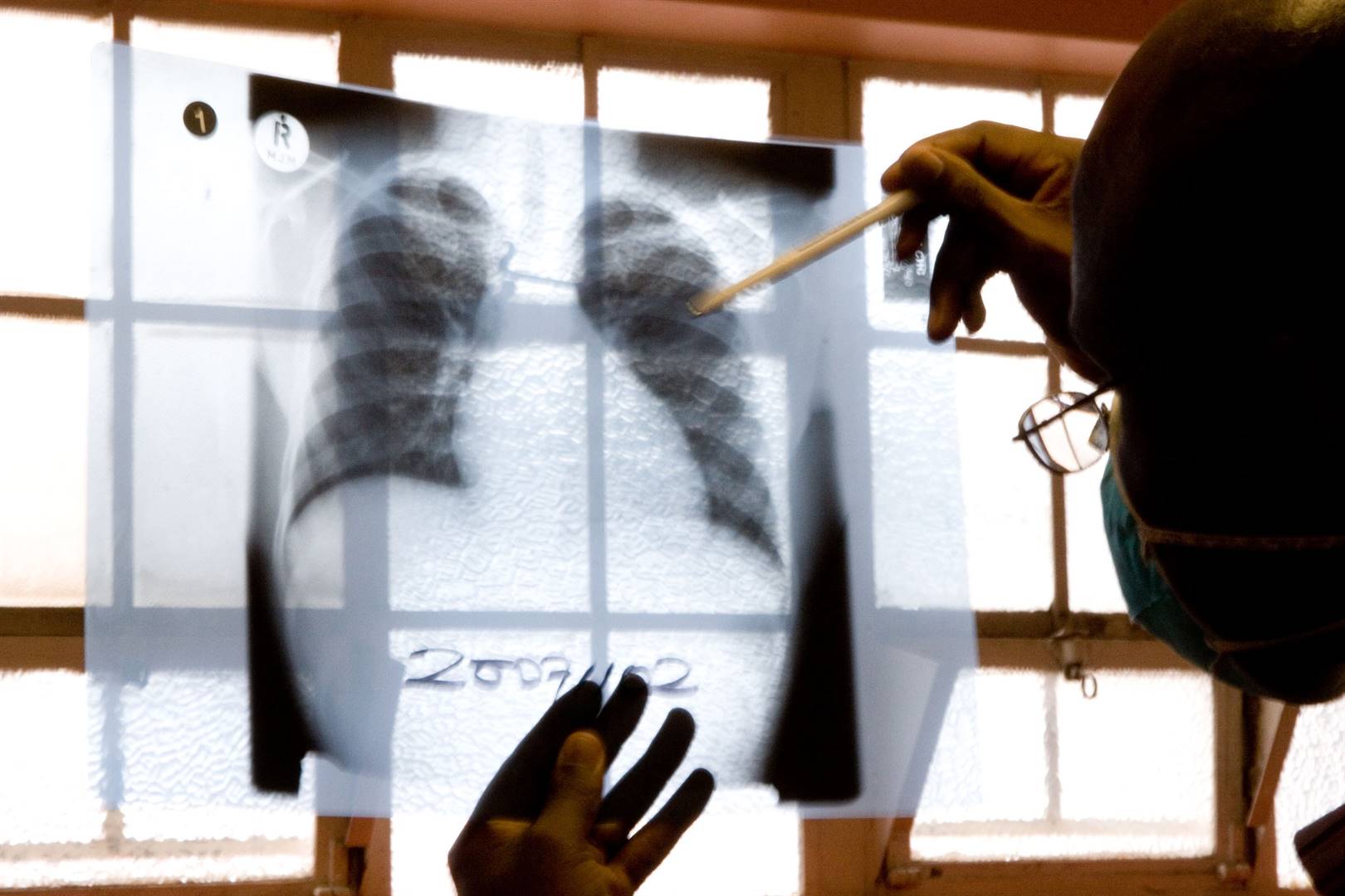 ’n Dokter kyk na X-strale van ’n long by ’n tuberkulose-kliniek.   Foto: Argief/AP