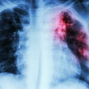 What is behind SA’s higher TB numbers?