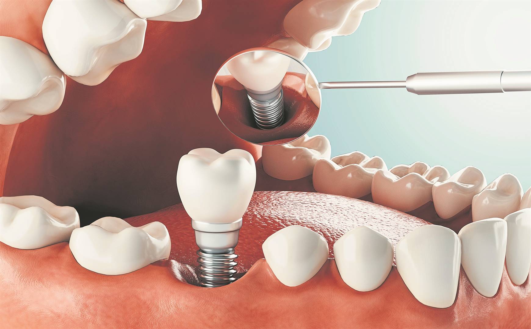 ’n Tandheelkundige inplantaat is ’n chirurgiese komponent wat gebruik word om ’n gat te vul waar jy ’n tand laat verwyder het. Foto: ISTOCK