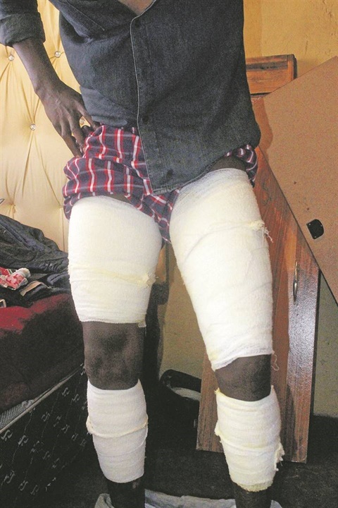 THE AFTERMATH:Lerato Sekopane’s lover burnt him with boiling water and oil. Inset: She also broke all his car windows.               Photo by  Collen Mashaba