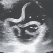 A giant, writhing worm was spotted on a sonogram inside a man's stomach - not for the faint of heart