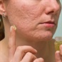 The development and stages of acne
