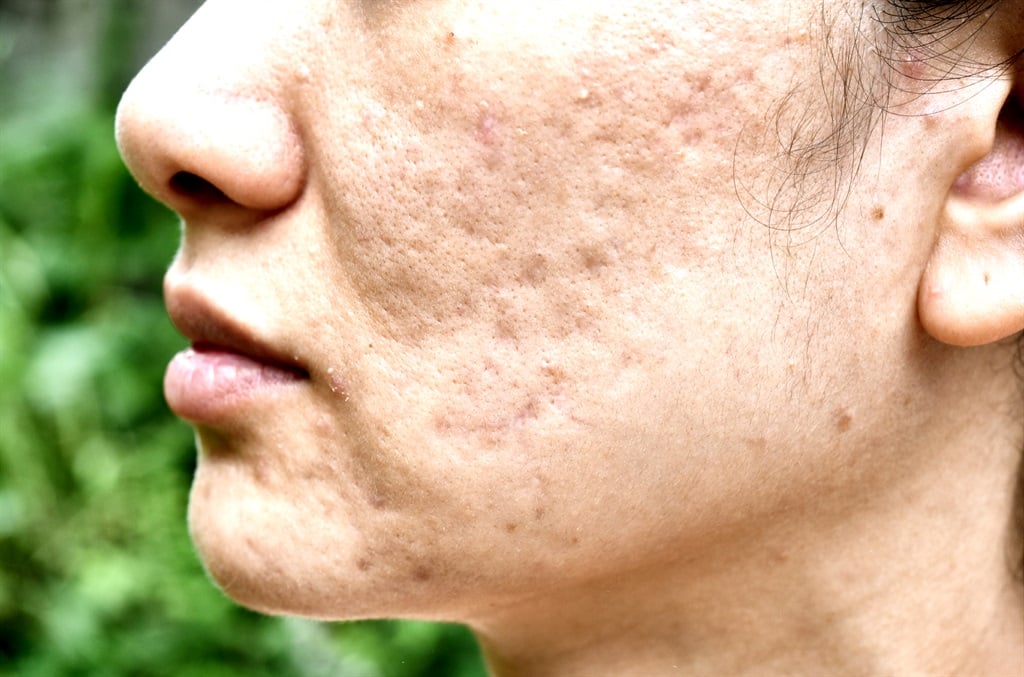 Acne scarring. (Getty Images)