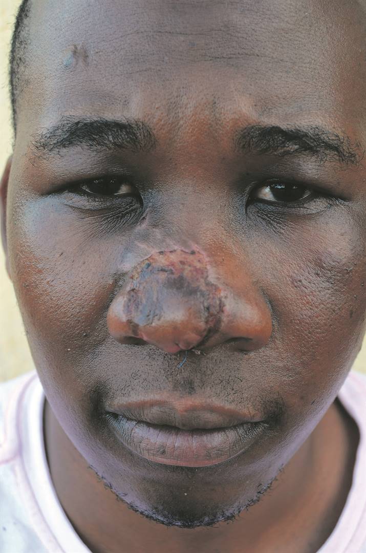 EISH!Kgaogelo Tshigeng, who was attacked by his lover, says Phokeng cops failed him.        Photo by   Rapula Mancai 
