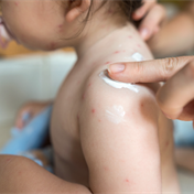 Here’s a guide to identify and treat five of the most common rashes in children