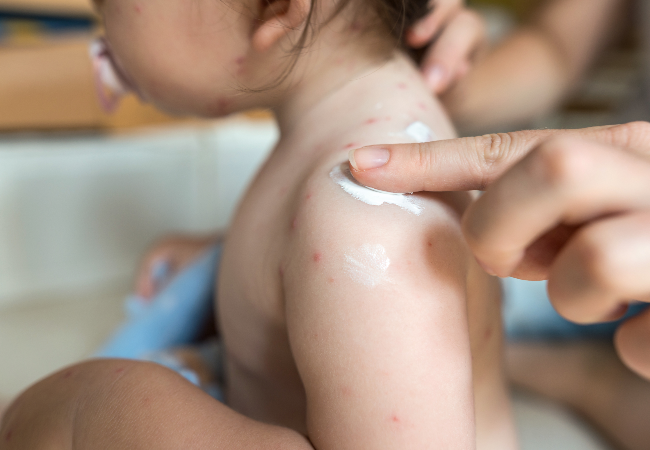 From German measles to hand-foot-and-mouth disease, we take a look at five of the most common rashes in kids (Photo: Getty Images/Gallo Images)