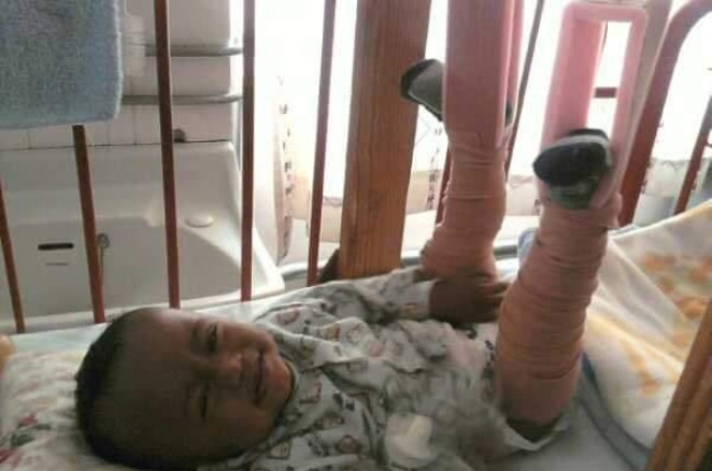 Deshaan in hospital with his very first fractures 
