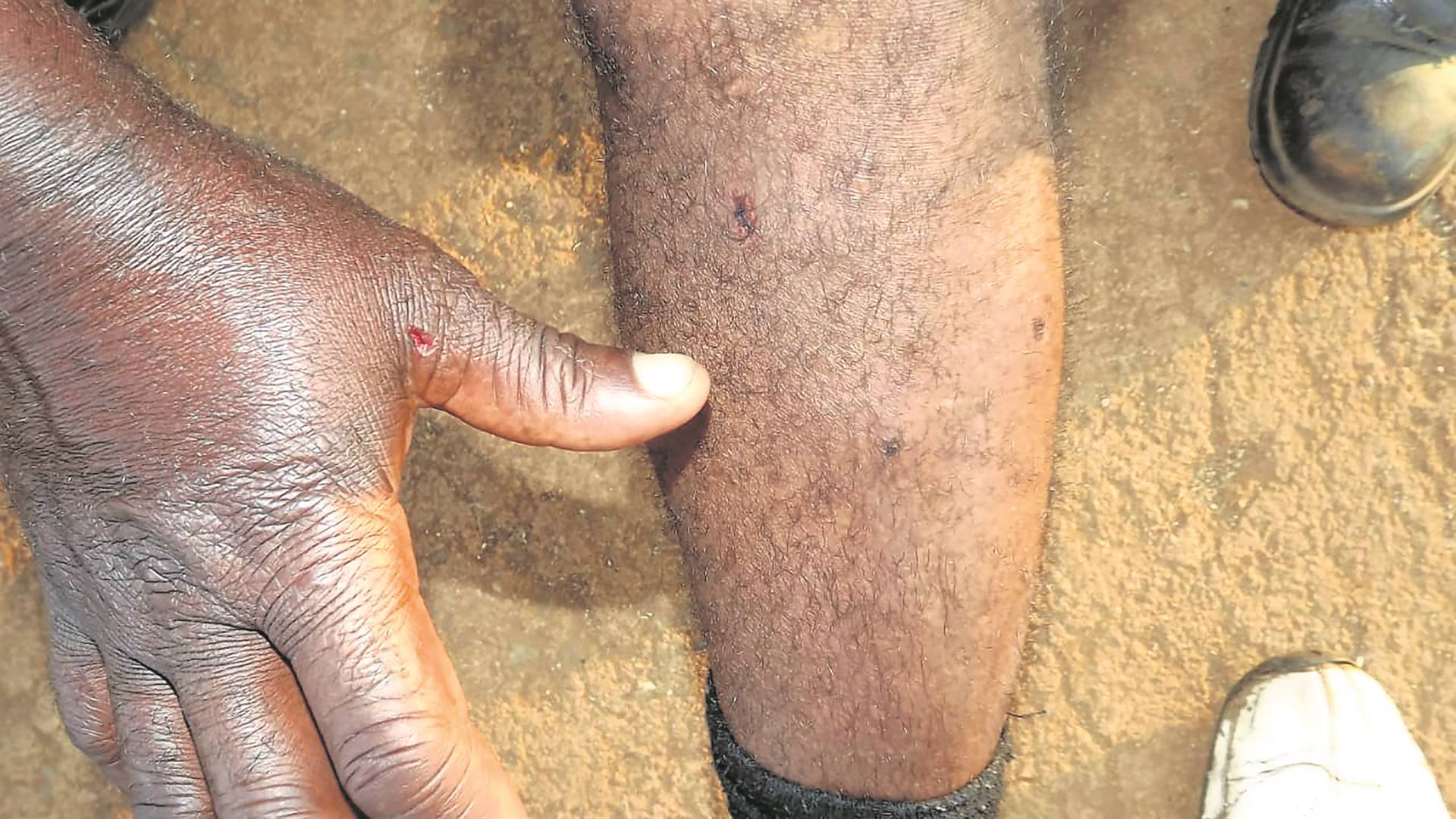 William Ndlazi shows where he was stabbed with a screwdriver on one of his legs. Photo by Sammy Moretsi