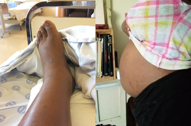 Cape Town woman shares the agony of having a 23cm fibroid that makes her  look pregnant