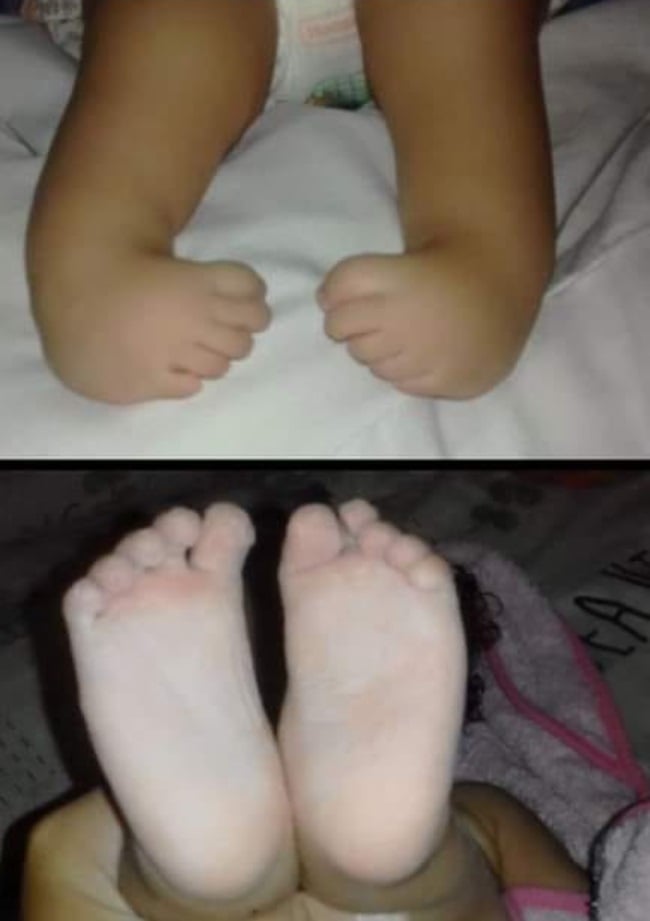 Both of Bailey's feet were turned inwards as a res
