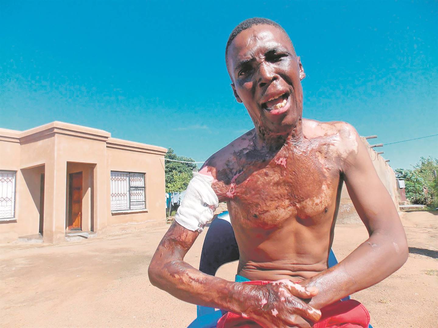Simon Marumo (42) from Winterveldt says George Mukhari Hospital left him in stress after the parrafin stove burnt him and the operation left his 4-5 and balls not working. Photo by Raymond Morare