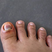 How to treat an ingrown toenail 