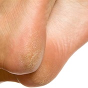 A guide to coping with corns and calluses