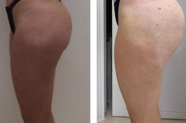Brazilian butt lift: behind the world's most dangerous cosmetic surgery