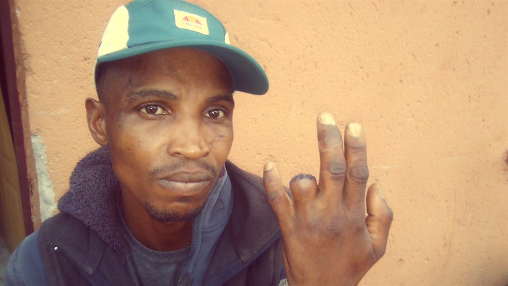Vusi Mahlangu's finger was cut off by a truck's tailgate. Photo by Bongani Mthimunye