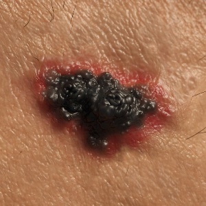 Smokers have a smaller chance of surviving melanoma. 