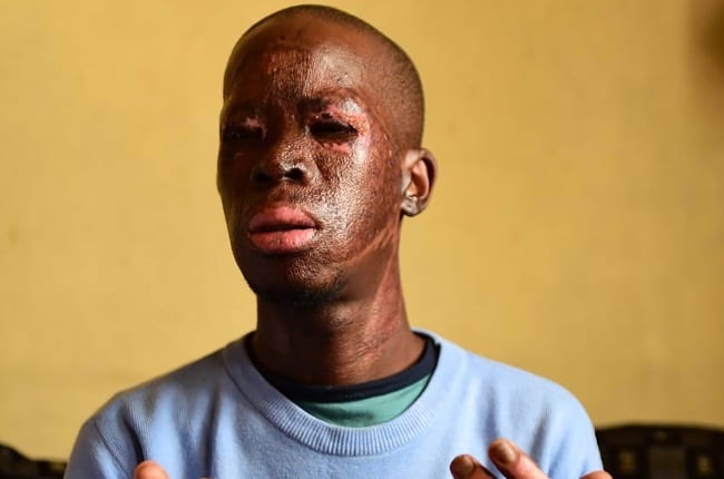 Zikhaya Sithole sustained burn injuries after trying to save children in a burning shack in 2020.