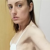 ‘I knew if I carried on I would die’: woman overcomes anorexia so severe the skin on her feet fell off