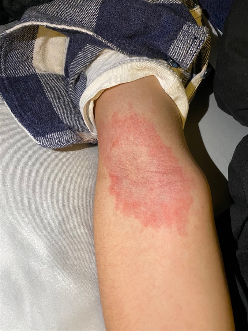 rash that get iritaed from touching it