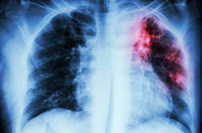 Kematian tuberkulosis meningkat lagi di Eropa – WHO