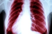 Risk factors for COPD?