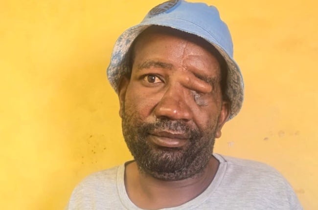 Trust Ndlovu, a game-farm security guard, has undergone extensive reconstructive surgery since he was brutally attacked by a hyena. (PHOTO: Supplied) 