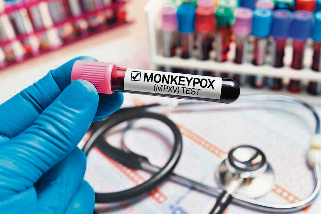 News24 | Hammanskraal pupil tests negative for mpox, Dept of Health confirms