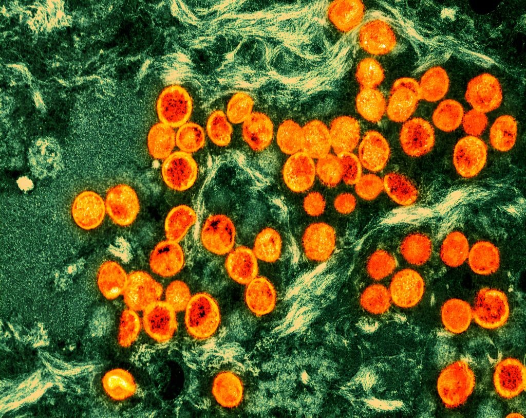 Colorized transmission electron micrograph of monkeypox virus particles (orange) found within an infected cell (green), cultured in the laboratory. (NIH-NIAID/IMAGE POINT FR/BSIP/Universal Images Group via Getty Images)