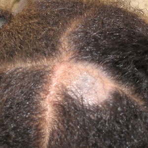 A child with ringworm of the scalp, or Tinea capitis. Source: CC BY-SA via Wikimedia Commons