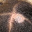 When ringworm causes hair loss in your child