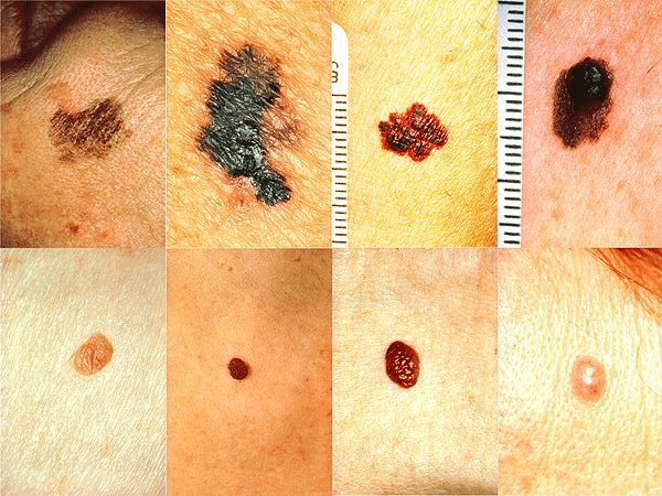 melanoma examples