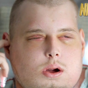 Pat Hardison sees his face for the first time since the transplant. Source:http://abcnews.go.com/ 