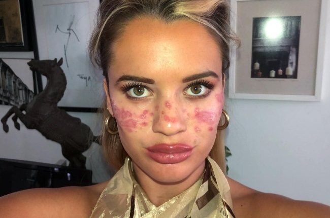 Tilly Whitfield was left with permanent scarring after she tattooed henna freckles on her cheeks. (PHOTO: Instagram/ @tillywhitfield)