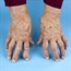 Rheumatoid arthritis may be linked to blood clots