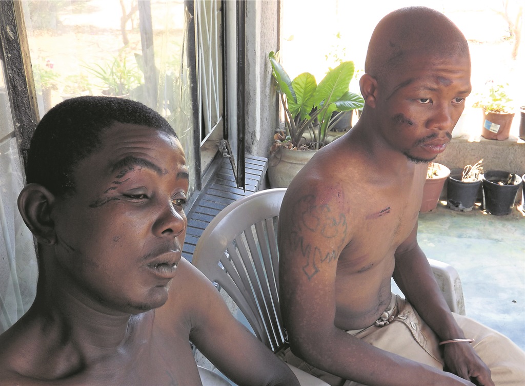 Christopher Hlabane and Thato Baloi show injuries they suffered when a farm owner allegedly tortured them.                        Photo by Doreen Mokgolo 