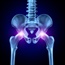 Exercise therapy helps severe hip osteoarthritis