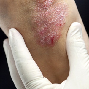 Psoriasis on elbow from Shutterstock