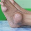 Gout more common amongst Americans