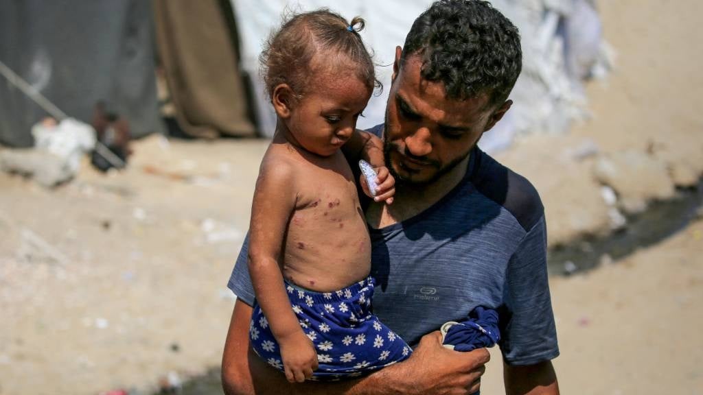 A man walks holding a child suffering from a rash 