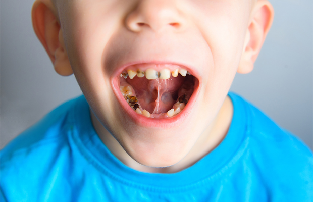 Young boy with cavities in his milk teeth